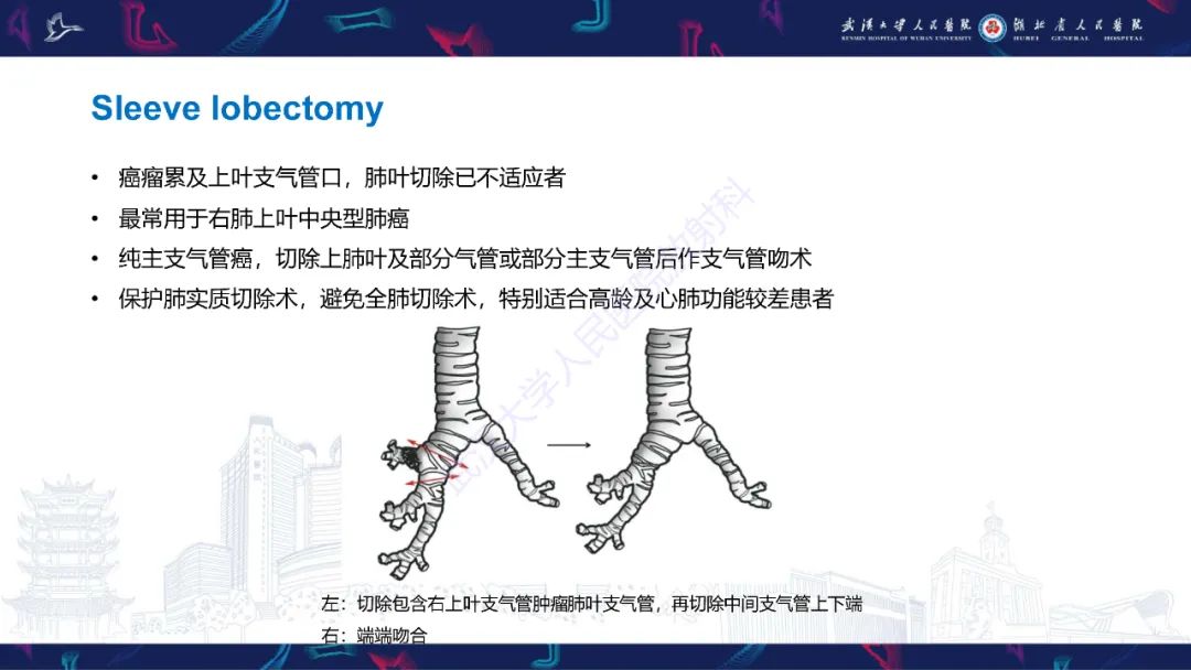 影像PPT - 【PPT】肺癌术后并发症影像诊断-24