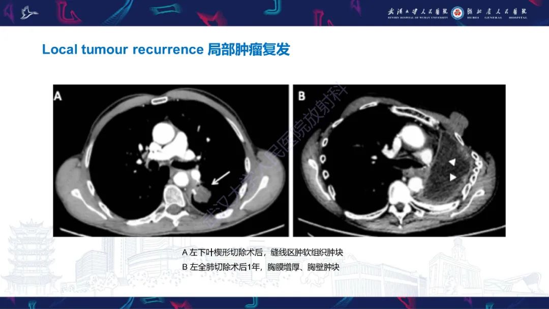 影像PPT - 【PPT】肺癌术后并发症影像诊断-41