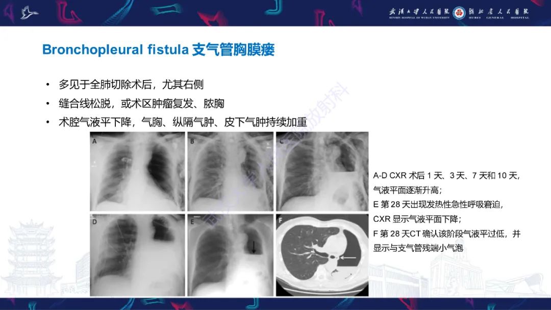 影像PPT - 【PPT】肺癌术后并发症影像诊断-27