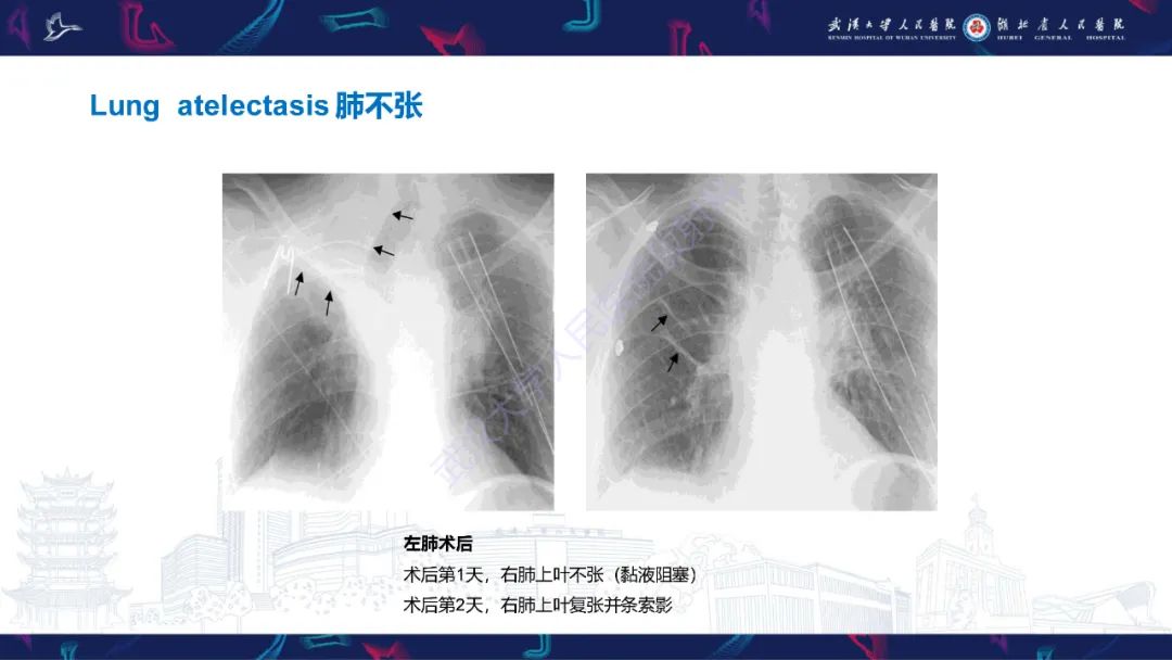 影像PPT - 【PPT】肺癌术后并发症影像诊断-31