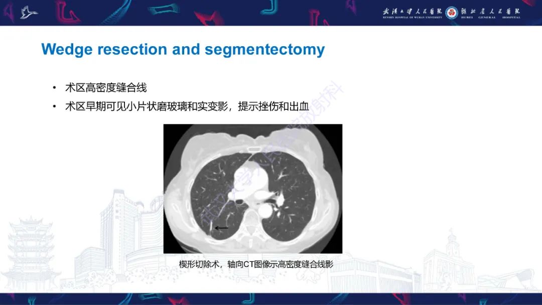 影像PPT - 【PPT】肺癌术后并发症影像诊断-17