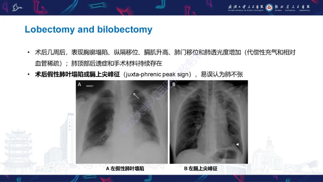 影像PPT - 【PPT】肺癌术后并发症影像诊断-19