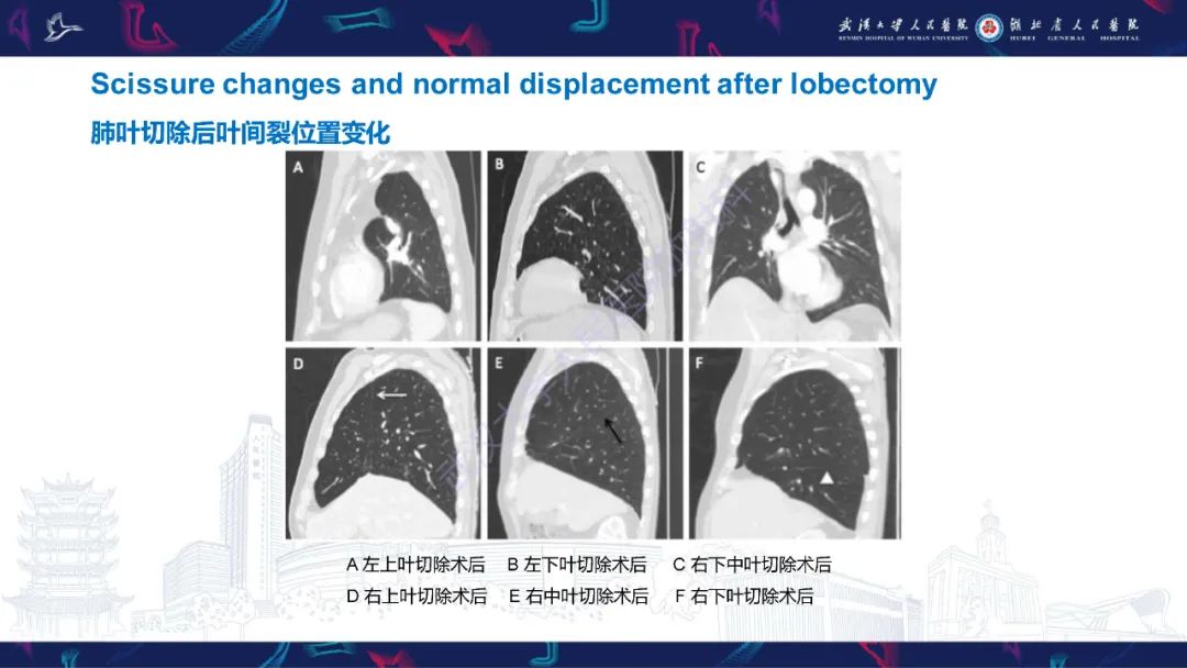 影像PPT - 【PPT】肺癌术后并发症影像诊断-20