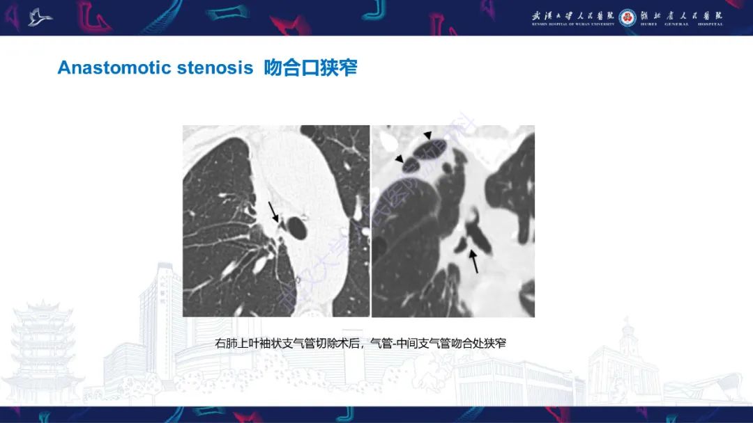 影像PPT - 【PPT】肺癌术后并发症影像诊断-46