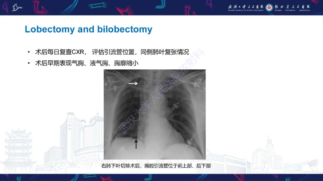 影像PPT - 【PPT】肺癌术后并发症影像诊断-18