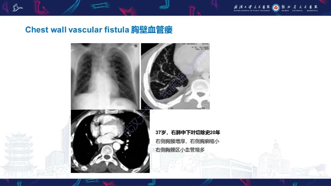 影像PPT - 【PPT】肺癌术后并发症影像诊断-45