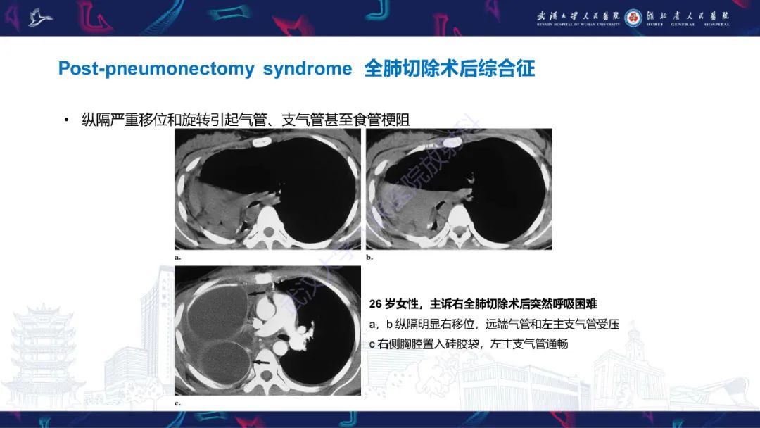 影像PPT - 【PPT】肺癌术后并发症影像诊断-44