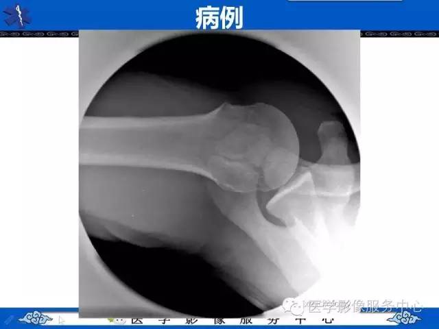 影像PPT - 肩峰骨—千万别被这东西迷惑成为骨折-1 影像PPT - 肩峰骨—千万别被这东西迷惑成为骨折-1