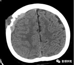 影像PPT - 【病例】颅骨骨结核1例CT及MR-2 影像PPT - 【病例】颅骨骨结核1例CT及MR-2