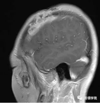 影像PPT - 【病例】颅骨骨结核1例CT及MR-6 影像PPT - 【病例】颅骨骨结核1例CT及MR-6