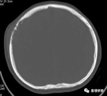 影像PPT - 【病例】颅骨骨结核1例CT及MR-3 影像PPT - 【病例】颅骨骨结核1例CT及MR-3