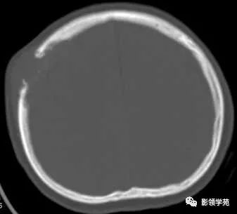 影像PPT - 【病例】颅骨骨结核1例CT及MR-4 影像PPT - 【病例】颅骨骨结核1例CT及MR-4