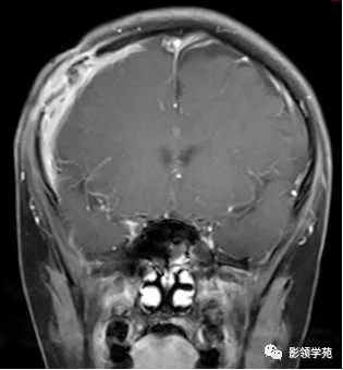 影像PPT - 【病例】颅骨骨结核1例CT及MR-5 影像PPT - 【病例】颅骨骨结核1例CT及MR-5