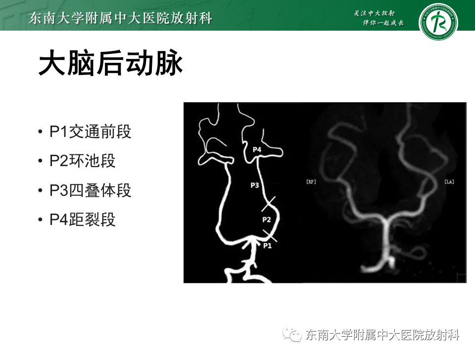 影像PPT - 【PPT】颅内外动脉狭窄的VWMRI诊断-8