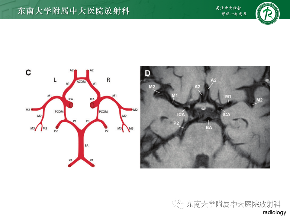 影像PPT - 【PPT】颅内外动脉狭窄的VWMRI诊断-9