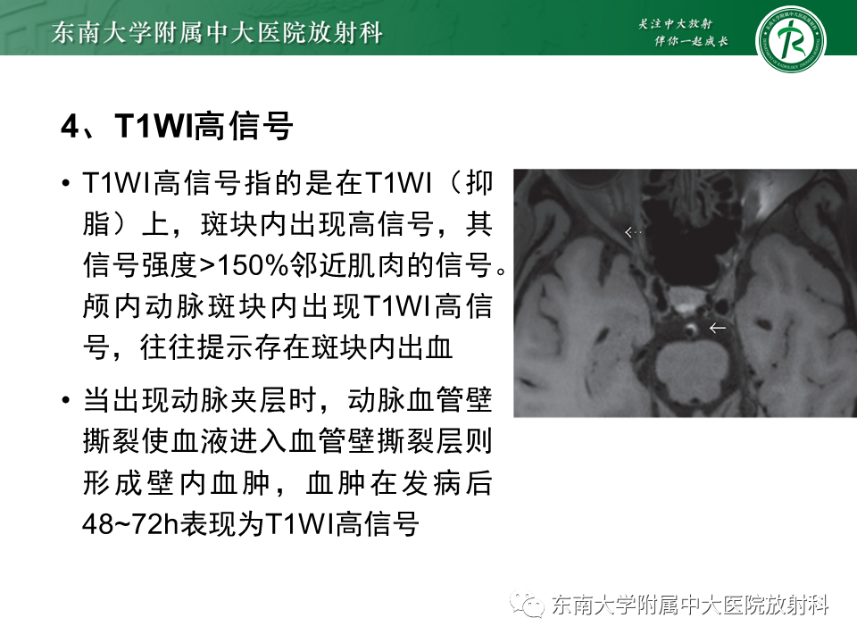 影像PPT - 【PPT】颅内外动脉狭窄的VWMRI诊断-14