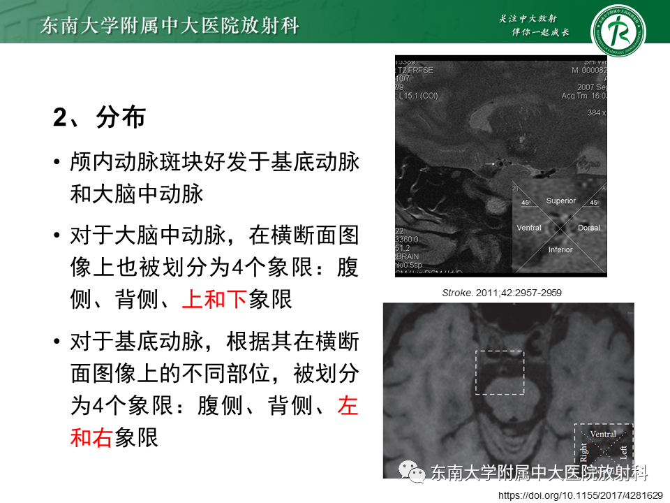 影像PPT - 【PPT】颅内外动脉狭窄的VWMRI诊断-12