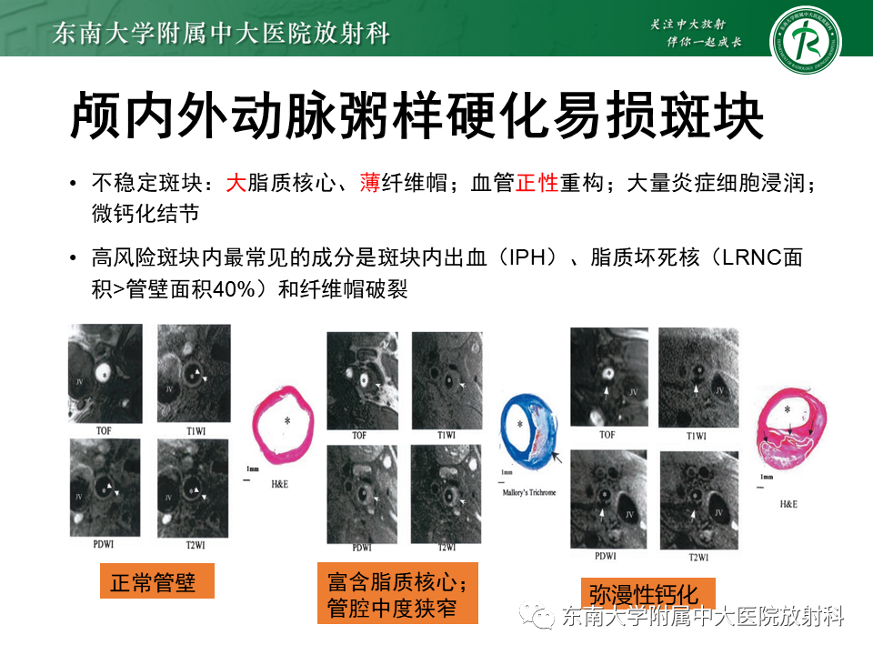 影像PPT - 【PPT】颅内外动脉狭窄的VWMRI诊断-19