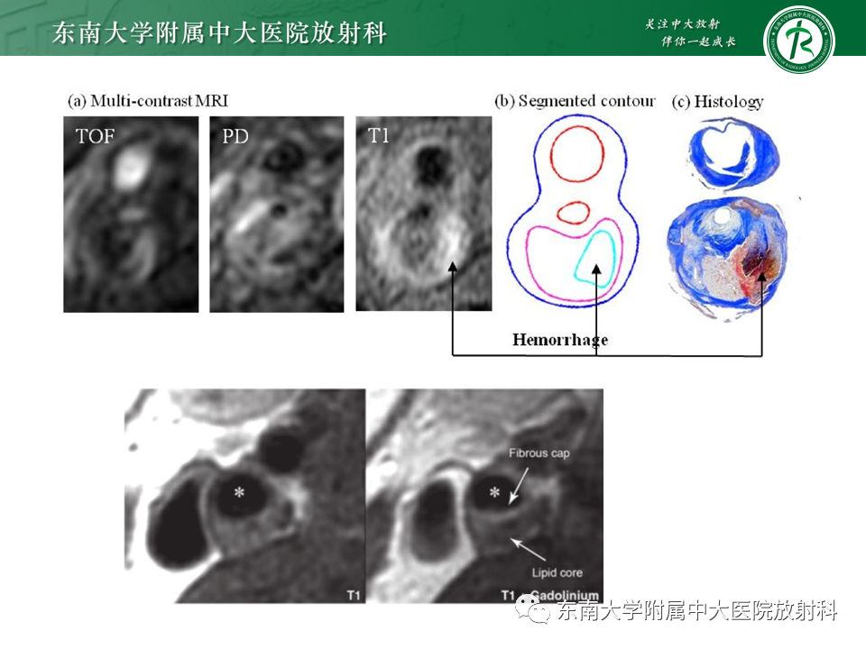 影像PPT - 【PPT】颅内外动脉狭窄的VWMRI诊断-20