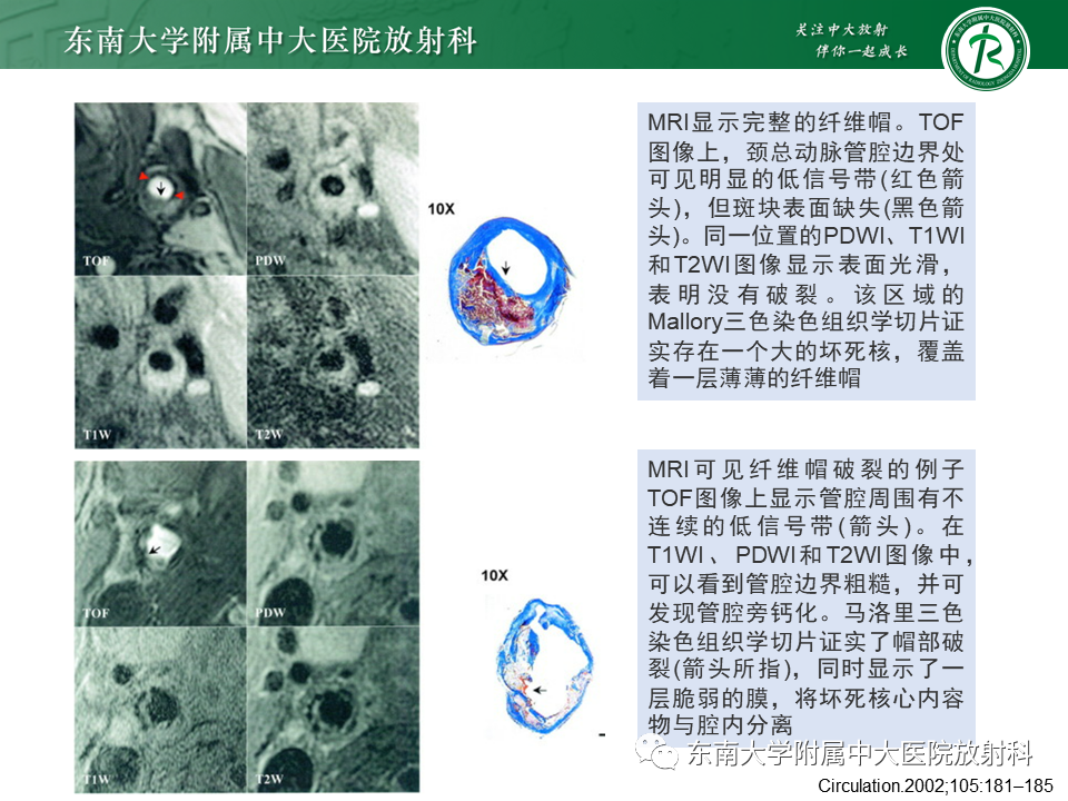 影像PPT - 【PPT】颅内外动脉狭窄的VWMRI诊断-21