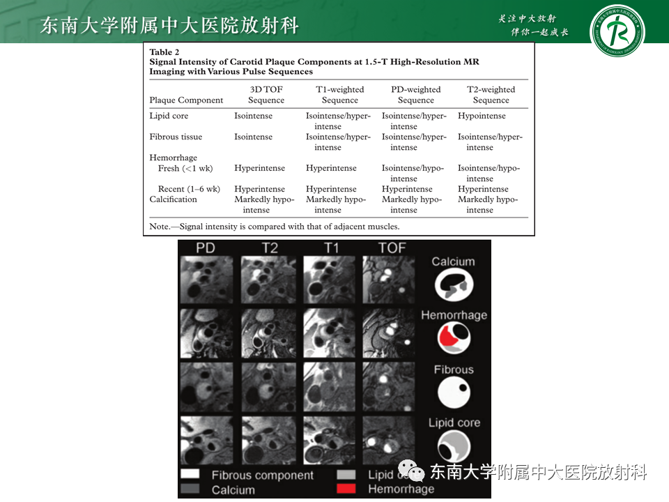 影像PPT - 【PPT】颅内外动脉狭窄的VWMRI诊断-22