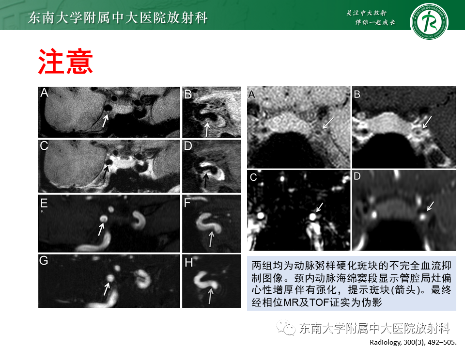 影像PPT - 【PPT】颅内外动脉狭窄的VWMRI诊断-23