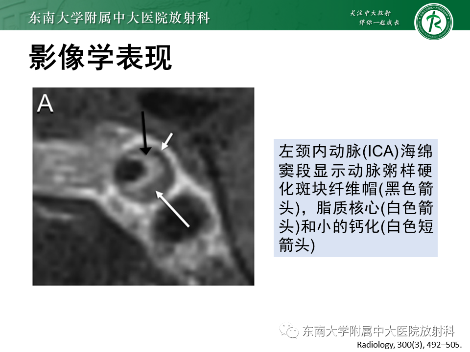 影像PPT - 【PPT】颅内外动脉狭窄的VWMRI诊断-24