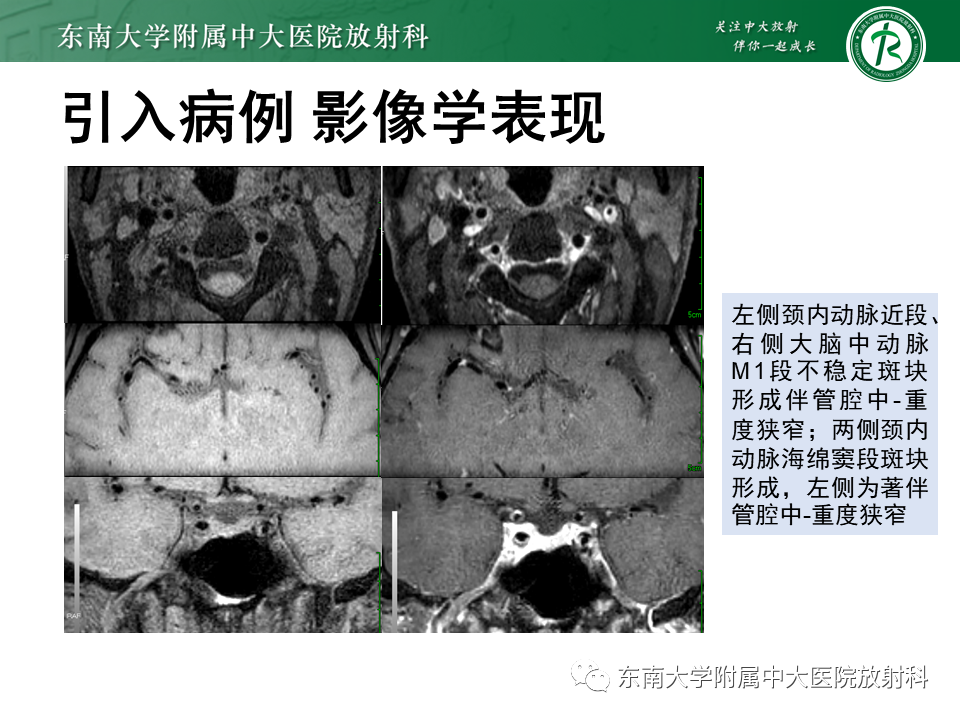 影像PPT - 【PPT】颅内外动脉狭窄的VWMRI诊断-25