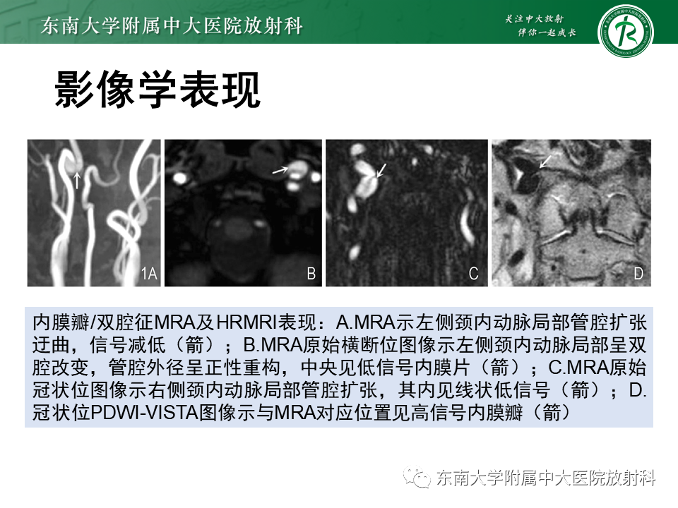 影像PPT - 【PPT】颅内外动脉狭窄的VWMRI诊断-27
