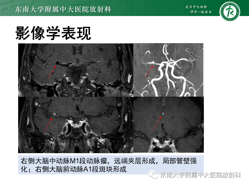 影像PPT - 【PPT】颅内外动脉狭窄的VWMRI诊断-28