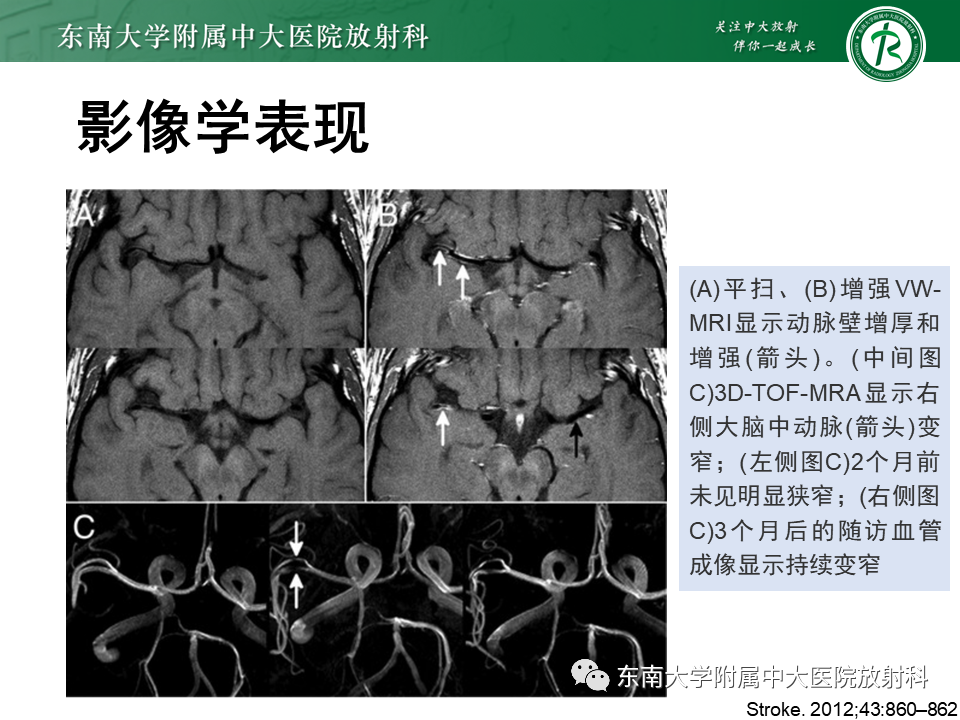 影像PPT - 【PPT】颅内外动脉狭窄的VWMRI诊断-30