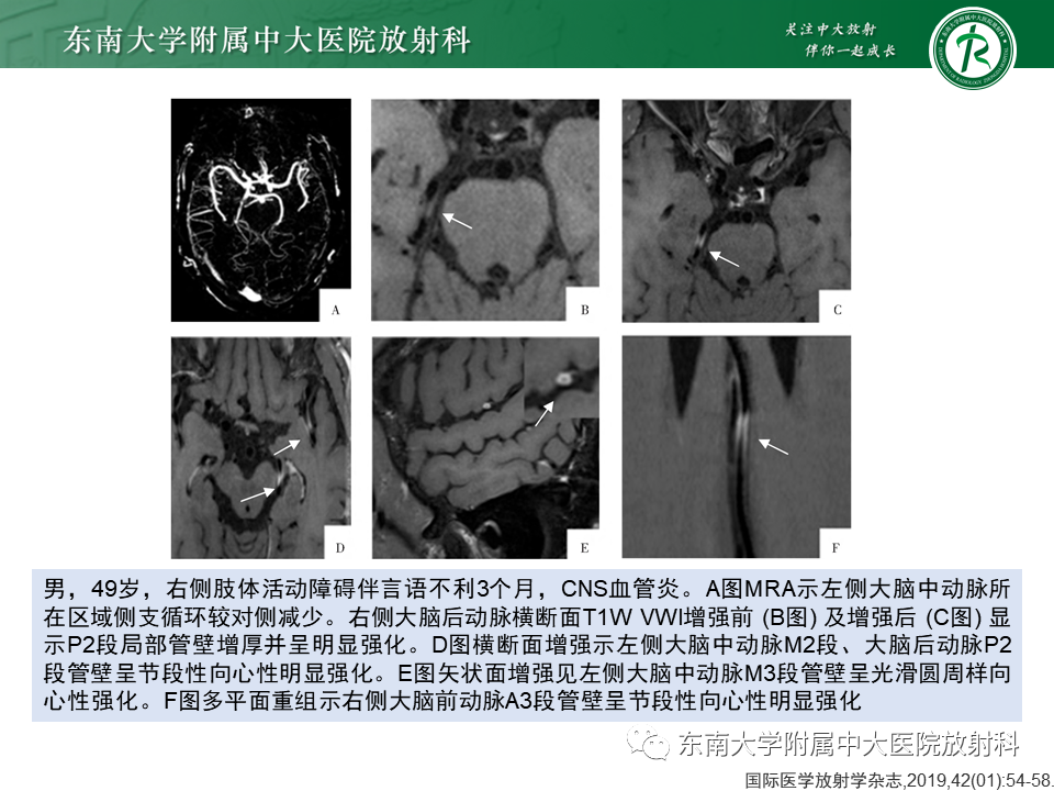 影像PPT - 【PPT】颅内外动脉狭窄的VWMRI诊断-31