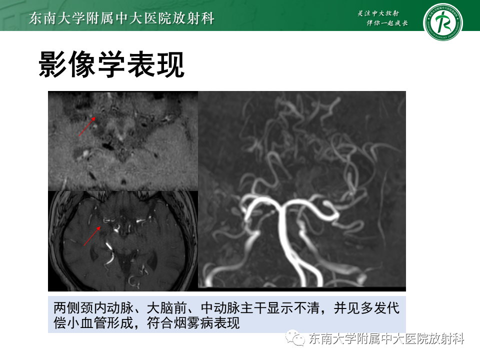 影像PPT - 【PPT】颅内外动脉狭窄的VWMRI诊断-33