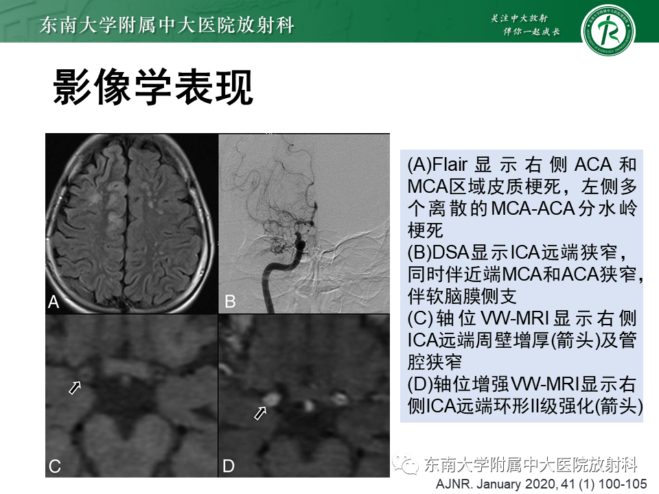 影像PPT - 【PPT】颅内外动脉狭窄的VWMRI诊断-35