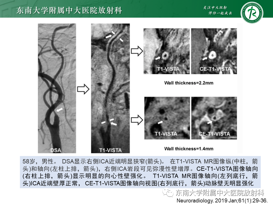 影像PPT - 【PPT】颅内外动脉狭窄的VWMRI诊断-34
