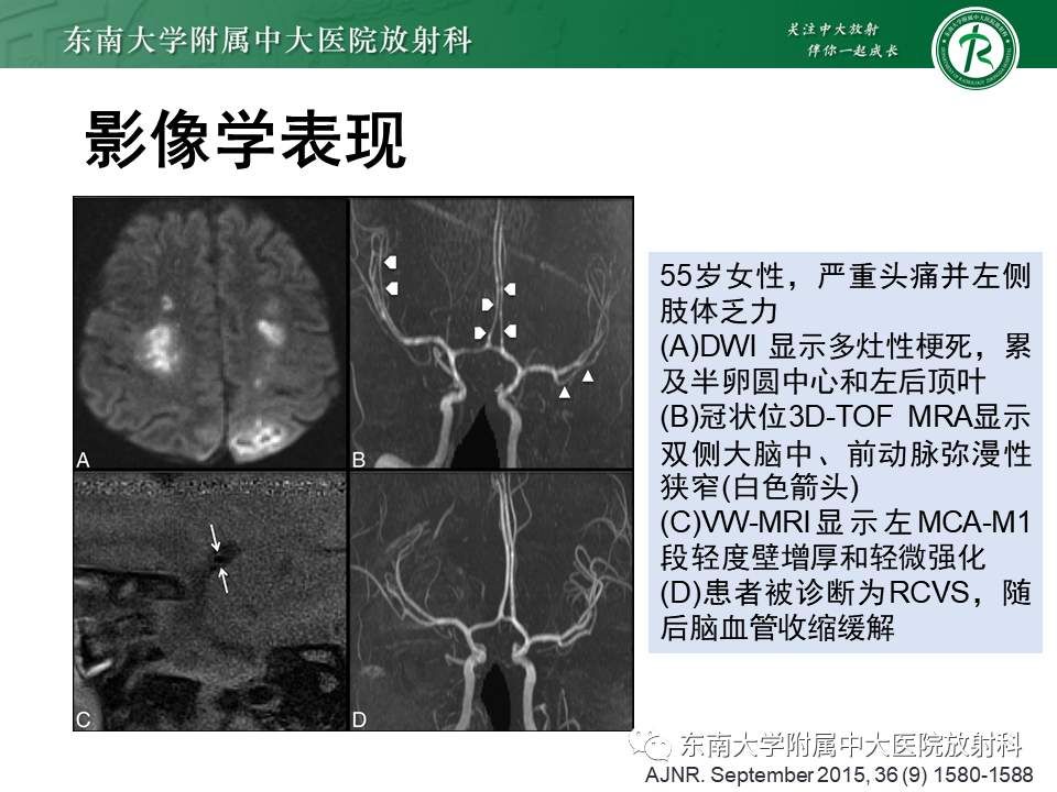 影像PPT - 【PPT】颅内外动脉狭窄的VWMRI诊断-38