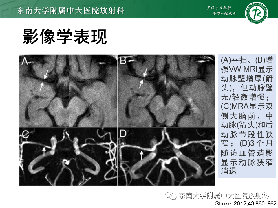 影像PPT - 【PPT】颅内外动脉狭窄的VWMRI诊断-39