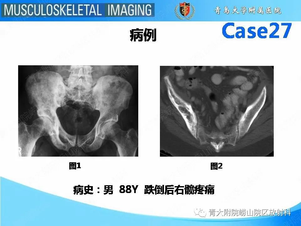 影像PPT - 【PPT】畸形性骨炎-2