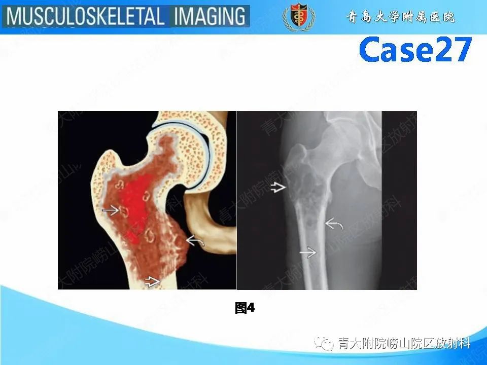 影像PPT - 【PPT】畸形性骨炎-7