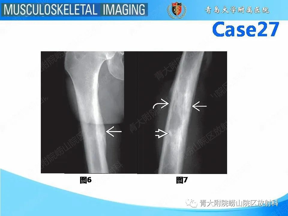 影像PPT - 【PPT】畸形性骨炎-10