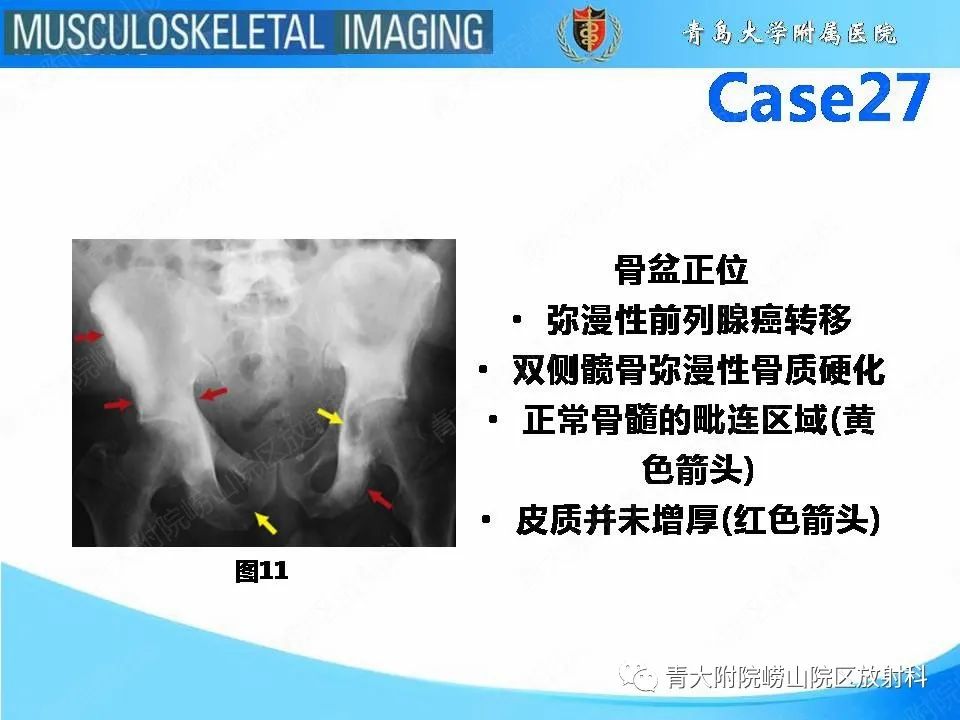 影像PPT - 【PPT】畸形性骨炎-12