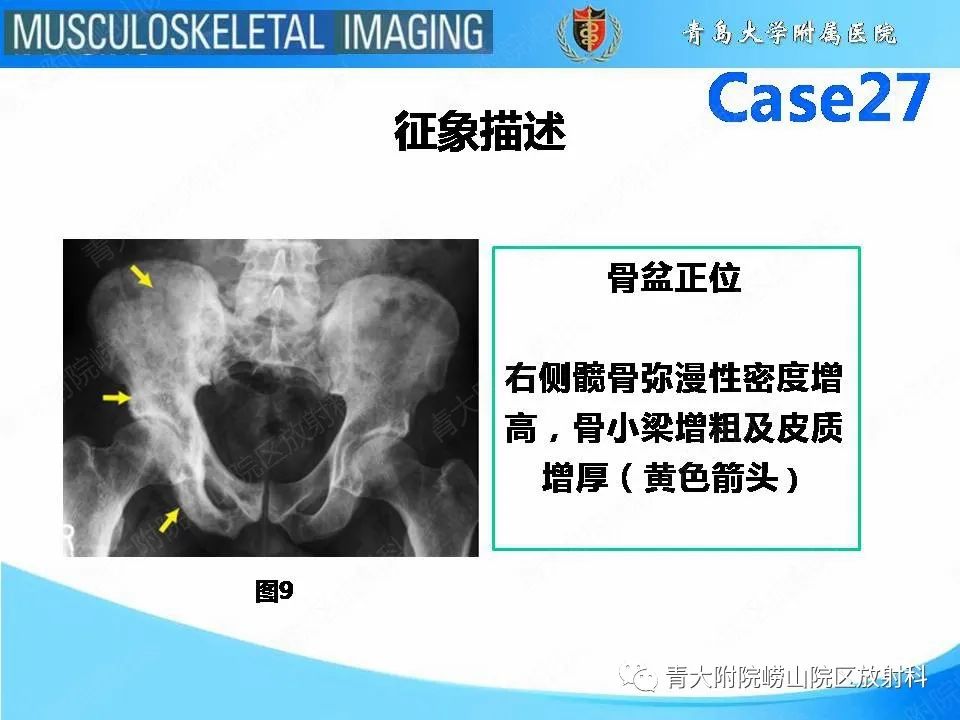 影像PPT - 【PPT】畸形性骨炎-19