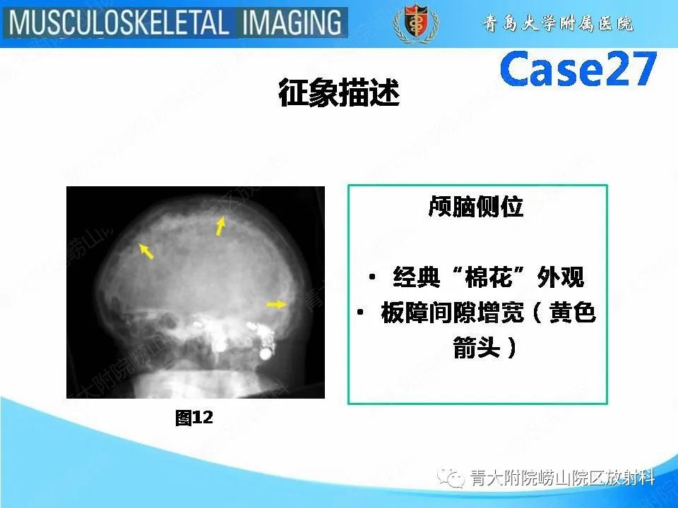 影像PPT - 【PPT】畸形性骨炎-21