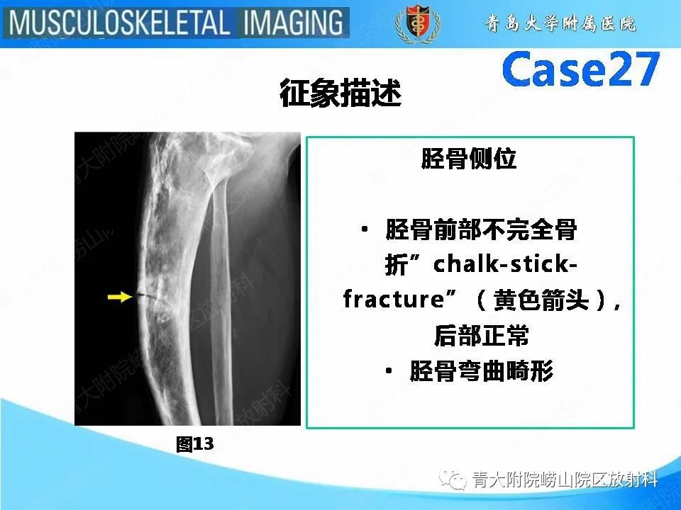 影像PPT - 【PPT】畸形性骨炎-22