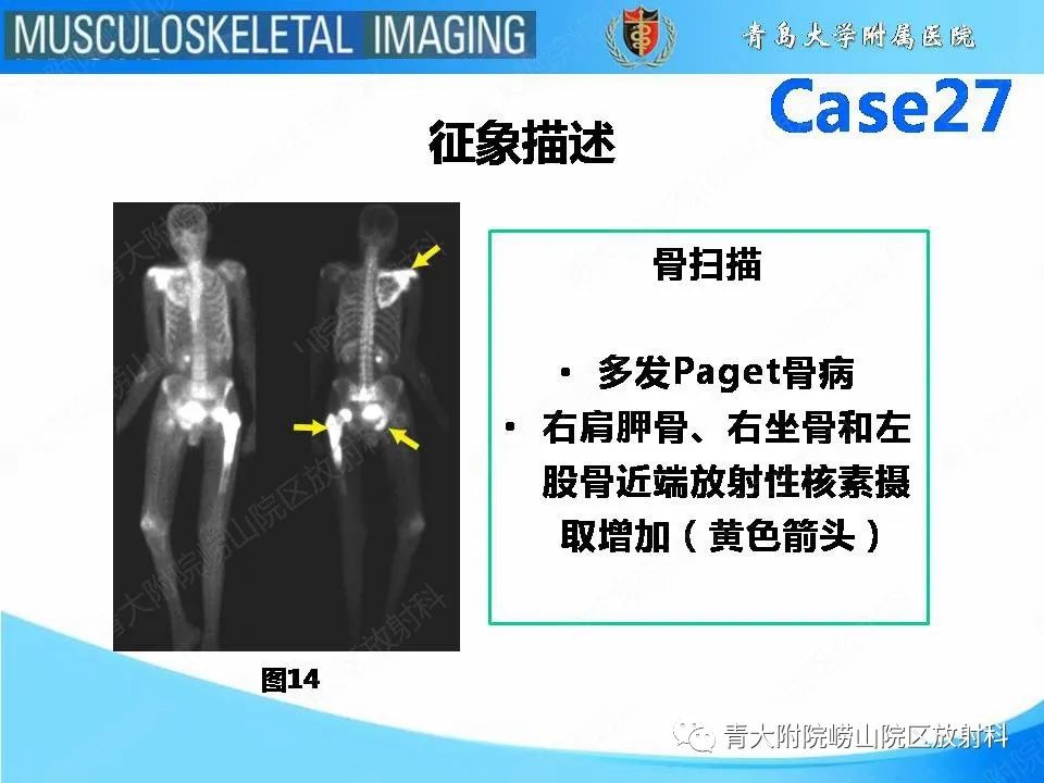 影像PPT - 【PPT】畸形性骨炎-23
