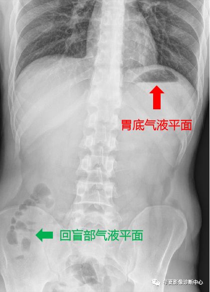 影像PPT - 肠梗阻X线表现-1 影像PPT - 肠梗阻X线表现-1