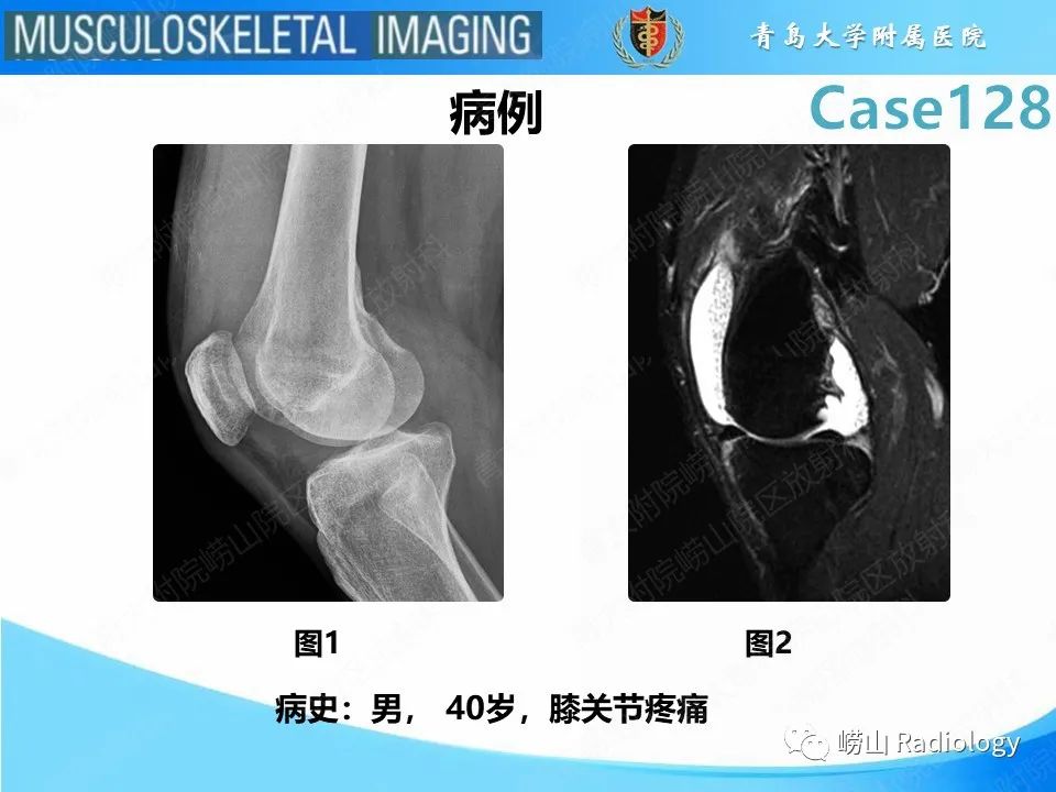 影像PPT - 【PPT】滑膜骨软骨瘤病-2
