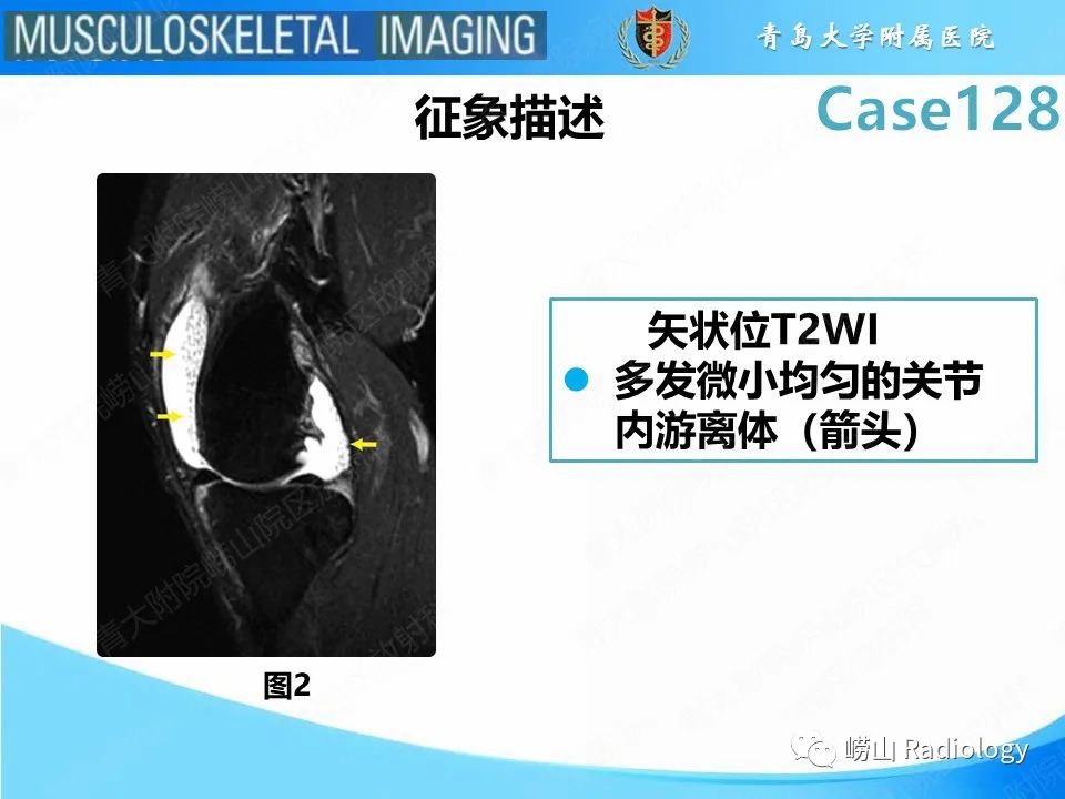 影像PPT - 【PPT】滑膜骨软骨瘤病-12