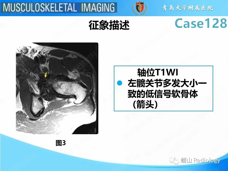 影像PPT - 【PPT】滑膜骨软骨瘤病-13