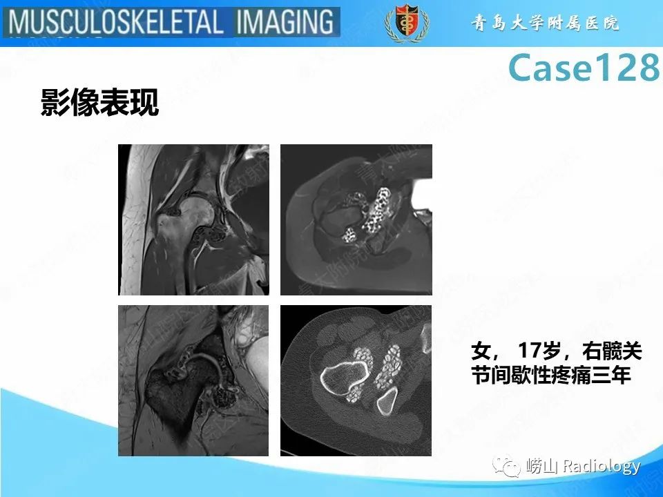 影像PPT - 【PPT】滑膜骨软骨瘤病-18